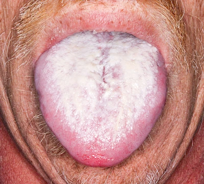 Beispiele: Belegte Zunge