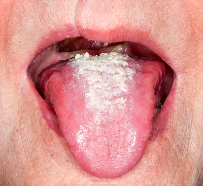 Beispiele: Belegte Zunge