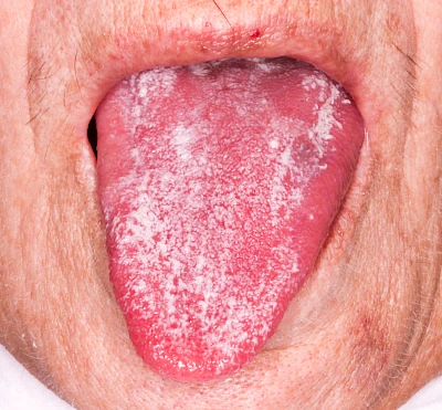 Beispiele: Belegte Zunge