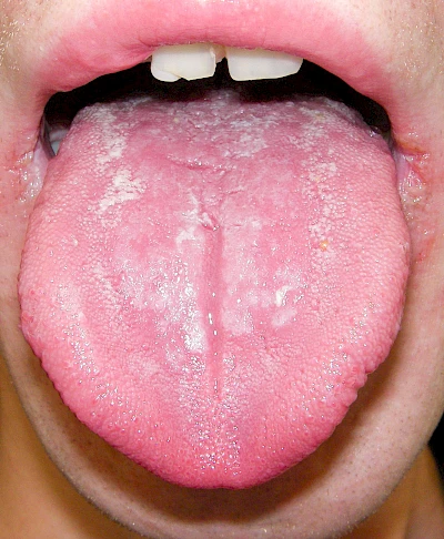 Beispiele: Belegte Zunge