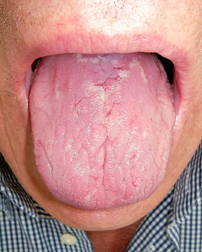 Beispiele: Belegte Zunge