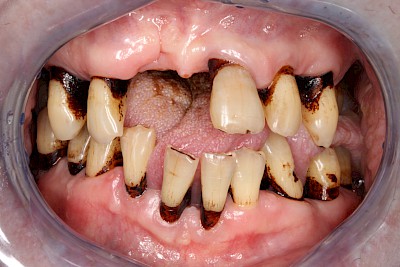 Starke Verfärbungen der Zähne bei sehr poröser Wurzeloberfläche infolge stark reduziertem Speichelfluss.