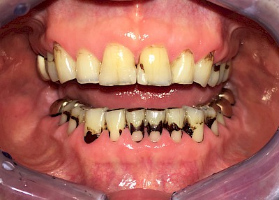 Starke Verfärbungen der Zähne bei sehr poröser Schmelzoberfläche infolge stark reduziertem Speichelfluss.