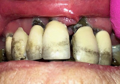 Grau- bzw. Braunverfärbung der Zähen infolge Zerbeissen von Eisentabletten im Mund