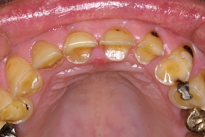 Beispiele: Abnutzung