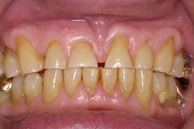 Beispiele: Abnutzung