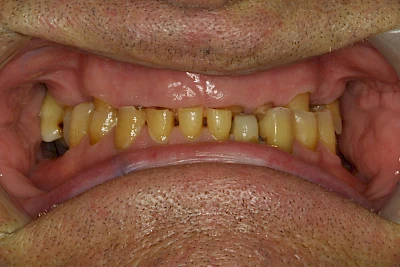 Beispiele: Abnutzung