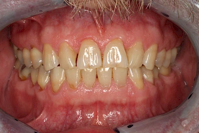 Beispiele: Keilförmiger Defekt