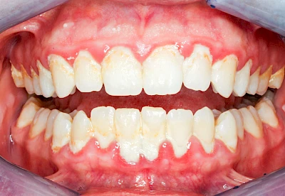 Beispiele: Gingivitis