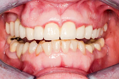 Beispiele: Gingivitis