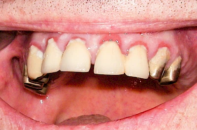 Beispiele: Gingivitis