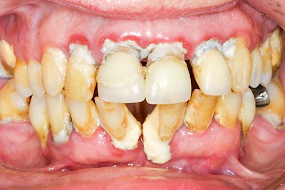 Beispiele: Parodontitis