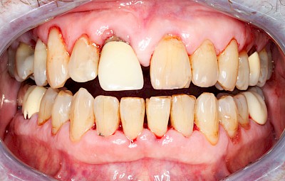 Beispiele: Parodontitis