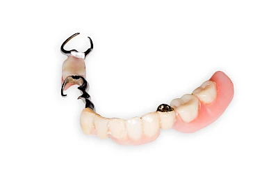 Beispiele: Peri-Implantitis