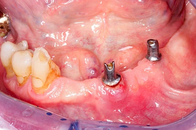 Beispiele: Peri-Implantitis
