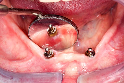Beispiele: Peri-Implantitis