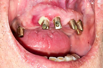 Beispiele: Peri-Implantitis