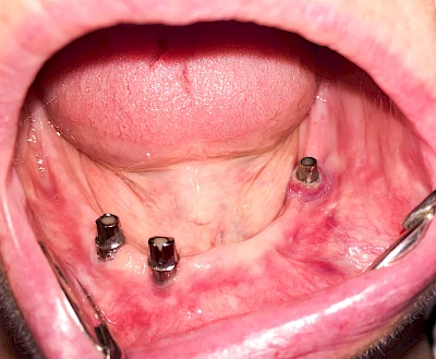 Beispiele: Peri-Implantitis