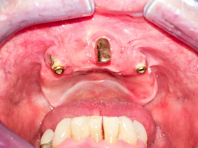 Beispiele: Peri-Implantitis