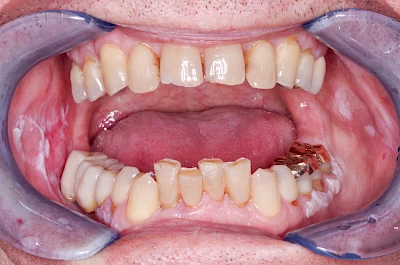 Beispiele: Leukoplakie, Erythroplakie