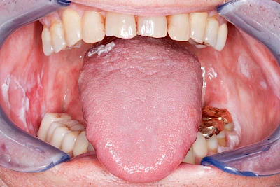 Beispiele: Leukoplakie, Erythroplakie