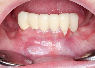 Beispiele: Leukoplakie, Erythroplakie
