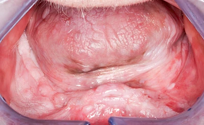 Beispiele: Leukoplakie, Erythroplakie