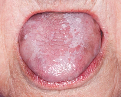 Beispiele: Leukoplakie, Erythroplakie