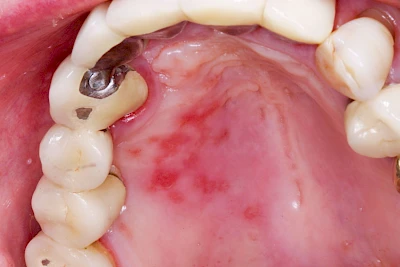 Beispiele: Herpes-Ausschlag