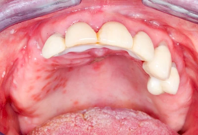 Beispiele: Herpes-Ausschlag