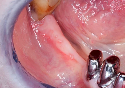 Beispiele: Herpes-Ausschlag