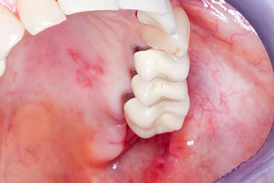 Beispiele: Herpes-Ausschlag