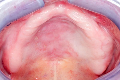 Beispiele: Herpes-Ausschlag