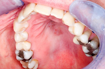 Beispiele: Herpes-Ausschlag