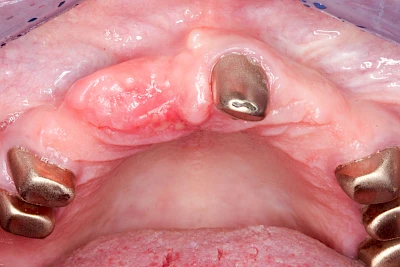 Beispiele: Herpes-Ausschlag