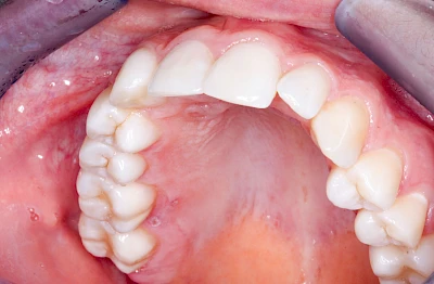 Beispiele: Herpes-Ausschlag