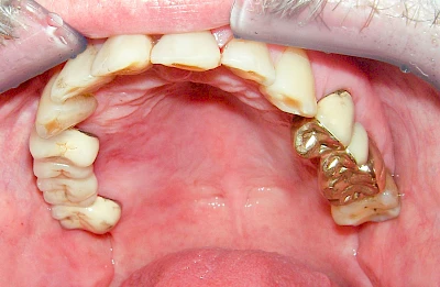 Beispiele: Herpes-Ausschlag