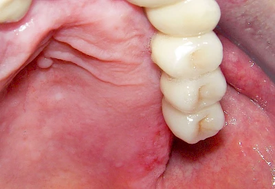 Beispiele: Herpes-Ausschlag