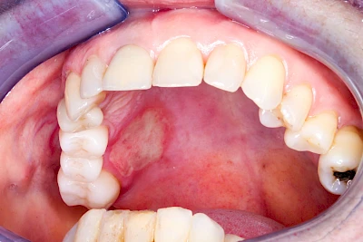 Beispiele: Verbrennung