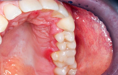 Beispiele: Verbrennung