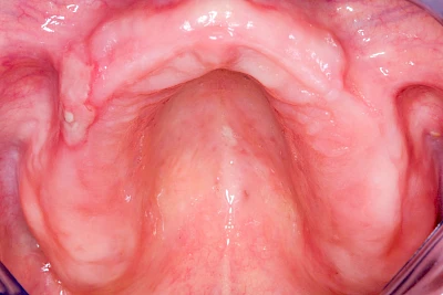 Beispiele: Verbrennung