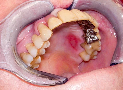 Beispiele: Verbrennung