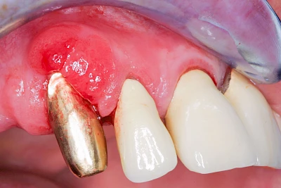 Beispiele: Schwellung mit Eiter (Abszess)