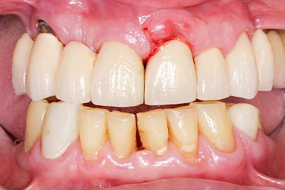 Beispiele: Schwellung mit Eiter (Abszess)