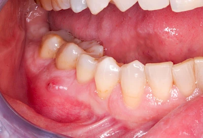 Beispiele: Schwellung mit Eiter (Abszess)