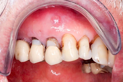 Beispiele: Schwellung mit Eiter (Abszess)