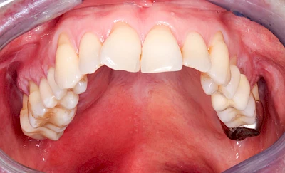 Beispiele: Schwellung mit Eiter (Abszess)