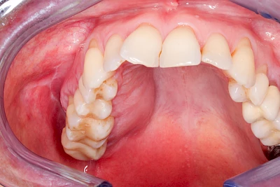 Beispiele: Schwellung mit Eiter (Abszess)