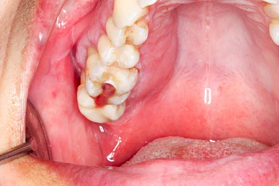 Beispiele: Schwellung mit Eiter (Abszess)