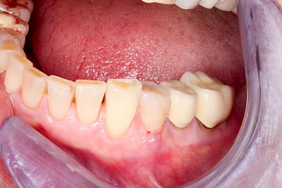 Beispiele: Schwellung mit Eiter (Abszess)